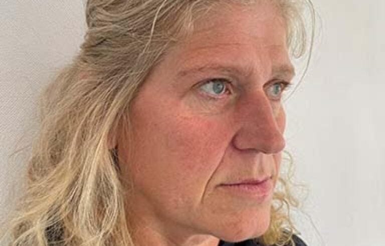 Before - Priyesh Lad Aesthetics