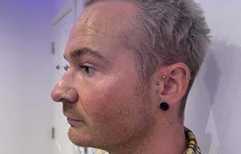 Before - Priyesh Lad Aesthetics