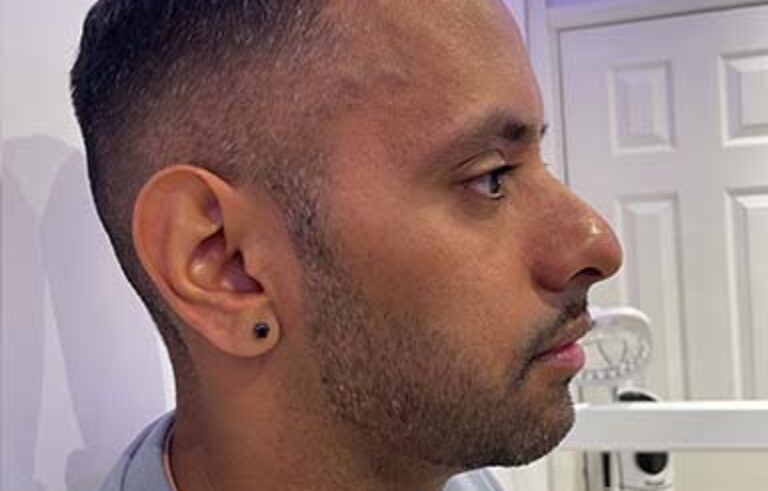 Before - Priyesh Lad Aesthetics